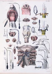 Tracheotomie-Operation, Tafel aus 